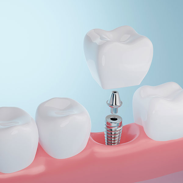 an illustration of white teeth, and a screw holding one tooth anchored to the gums.